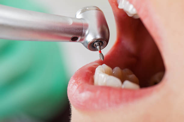Best Broken or Cracked Tooth Emergency Dentist in Alexandria, VA